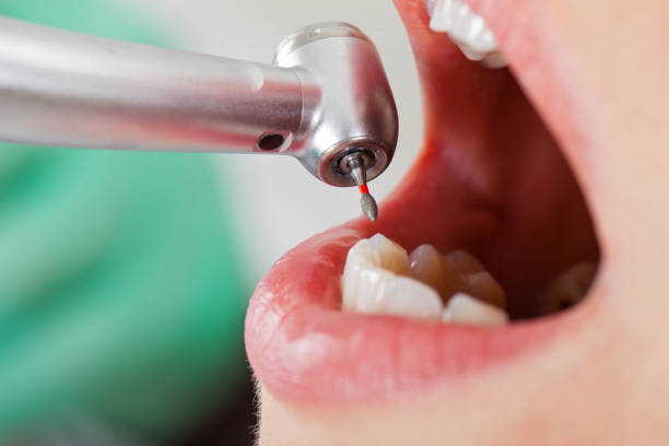 Best Emergency Dentist for Knocked-Out Tooth in Shady Hollow, TX